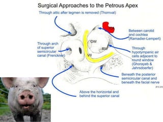 Infratemporal fossa approach –A & B
Transpetrous approach
 