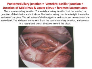 Surgical Anatomy after Opening the
posterior cranial fossa dura
Drilling of the cochlea (Co). Drilling of the petrous apex (PA).
 