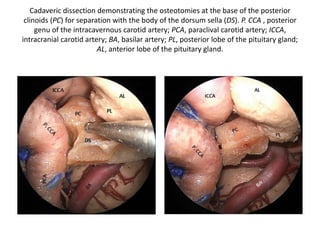 Tilting the microscope downward,
both the ipsilateral (VA)
and contralateral (VAc) vertebral
arteries come into view.
With a slight retraction of the middle fossa dura,
the origin of
the superior cerebellar artery at the basilar artery
(BA) can be seen. Note
the excellent control of the trigeminal nerve (V).
 