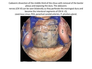 Mild retraction of the tentorium (Ten)
provides a good view of
the oculomotor nerve (III) and its relation
to the superior cerebellar
artery (SCA) lying inferiorly and the
posterior cerebral artery (PCA) lying
superiorly. The trochlear nerve (IV) is seen
running on the undersurface
of the tentorium.
Meckel’s cave (MC) can be
opened when necessary.
 