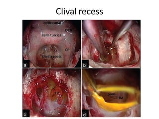 The Type C Modified Transcochlear
Approach – after cutting the
tentorium
With mild retraction of the temporal lobe, the bifurcation of the internal
carotid artery (ICA) into the anterior (ACA) and middle cerebral (MCA) arteries
is seen. The ipsilateral (ON) and contralateral (ONc) optic nerves are seen. The
oculomotor nerve (III) is embraced by the posterior cerebral artery (PCA)
superiorly and the superior cerebellar artery (SCA) inferiorly
 