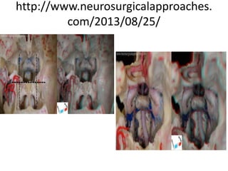 INFRA-COCHLEAR approach
through BRACKS MANS TRIANGLE
 