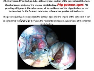 Between the fustis and the finiculus a subcochlear canaliculus is often seen, which is a
tunnel that connects the round window chamber with the petrous apex via a series of
pneumatized cells.
Right ear. Endoscopic anatomy of inferior retrotympanum. fu fustis, t tegmen, pp
posterior pillar, f finiculus, j jacobson’s nerve
 