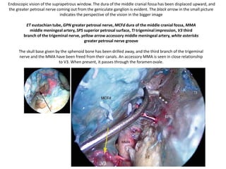 Right ear. Endoscopic anatomy of the retrotympanum during
dissection for acustic neuroma surgery.
fu fustis, fn facial nerve, ow oval window, pr promontory, scc
subcochlear canaliculus, et Eustachian tube
 