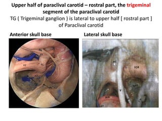 Right ear. Endoscopic dissection during surgery, after drilling the
promontory. ow oval window, st scala tympani, scc subcochlear
canaliculus
 