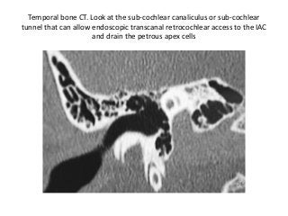 Temporal bone CT. Look at the sub-cochlear canaliculus or sub-cochlear
tunnel that can allow endoscopic transcanal retrocochlear access to the IAC
and drain the petrous apex cells
 