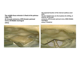 The mid- coronal and posterior coronal planes are divided into 7 anatomic
zones based on the relationship to the ICA.
• Zone 1 represents the anterior petrous apex.
• Zone 2 represents the mid- body of the petrous bone below the level of the horizontal
• segment of the petrous carotid.
• Zone 3 represents the suprapetrous region consisting of the quadrangular space.
• The quadrangular space is defined medially by the paraclival ICA, inferiorly by the
• horizontal segment of the petrous ICA, laterally by the second division of the trigeminal
• nerve, and superiorly by the course of the sixth cranial nerve within the cavernous
• sinus. Through this approach Meckel’s cave and the gasserian ganglion can be
• reached.
• Zone 4 represents the superior lateral cavernous sinus, representing the region
• through which the oculomotor (III), trochlear (IV), first division of the trigeminal
• nerve, and abducens (VI) nerves traverse.
• Zone 5 represents the transpterygoid /infratemporal space with direct access to the
• middle fossa.
• Zone 6 represents the region of the condyle. It is the paramedian area located
• immediately lateral to the inferior third of the clivus and foramen magnum. It is
• antero- laterally bounded by the eustachian tube and fossa of Rosenmuller that mark
• the parapharyngeal ICA laterally. Superiorly, it has its limit on the petroclival synchondrosis.
• Lesions in this region can involve the hypoglossal canal.
• Zone 7 represents the region lateral to the parapharyngeal ICA. The approach for
• this region extends along the floor of the maxillary sinus and contains the lateral
• pterygoid plate and attached soft tissue. Most importantly, this region contains the
• jugular foramen posteriorly.
 