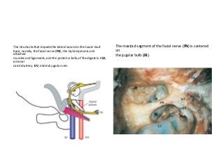 The structures that impede the lateral access to the lower skull
base, namely, the facial nerve (FN), the styloid process and
attached
muscles and ligaments, and the posterior belly of the digastric. ICA,
internal
carotid artery; IJV, internal jugular vein.
The mastoid segment of the facial nerve (FN) is centered
on
the jugular bulb (JB).
 