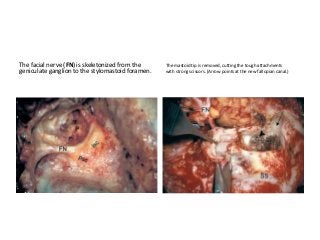 The facial nerve (FN) is skeletonized from the
geniculate ganglion to the stylomastoid foramen.
The mastoid tip is removed, cutting the tough attachments
with strong scissors. (Arrow points at the new fallopian canal.)
 