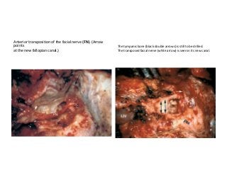 Anterior transposition of the facial nerve (FN). (Arrow
points
at the new fallopian canal.)
The tympanic bone (black double arrows) is still to be drilled.
The transposed facial nerve (white arrow) is seen in its new canal.
 