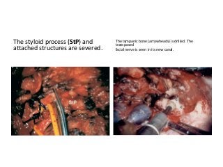 The styloid process (StP) and
attached structures are severed.
The tympanic bone (arrowheads) is drilled. The
transposed
facial nerve is seen in its new canal.
 