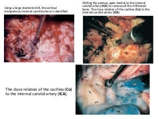 Using a large diamond drill, the vertical
intrapetrous internal carotid artery is identified.
Drilling the petrous apex medial to the internal
carotid artery (ICA) to remove all the infiltrated
bone. The close relation of the cochlea (Co) to the
internal carotid artery (ICA).
The close relation of the cochlea (Co)
to the internal carotid artery (ICA).
 