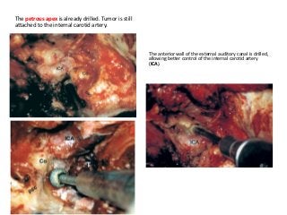 The petrous apex is already drilled. Tumor is still
attached to the internal carotid artery.
The anterior wall of the external auditory canal is drilled,
allowing better control of the internal carotid artery
(ICA).
 