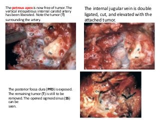 The petrous apex is now free of tumor. The
vertical intrapetrous internal carotid artery
has been liberated. Note the tumor (T)
surrounding the artery.
The internal jugular vein is double
ligated, cut, and elevated with the
attached tumor.
The posterior fossa dura (PFD) is exposed.
The remaining tumor (T) is still to be
removed. The opened sigmoid sinus (SS)
can be
seen.
 