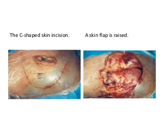 The C-shaped skin incision. A skin flap is raised.
 