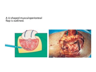 A U-shaped musculoperiosteal
flap is outlined.
 