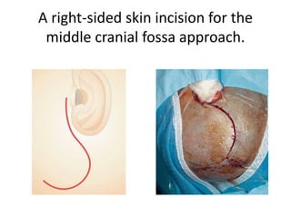 Quadrangular part boarders –
Zone 3 represents the
suprapetrous region
consisting of the
quadrangular space.
The quadrangular space is
defined medially by the
paraclival ICA, inferiorly by
the
horizontal segment of the
petrous ICA, laterally by the
second division of the
trigeminal
nerve, and superiorly by the
course of the sixth cranial
nerve within the cavernous
sinus. Through this approach
Meckel’s cave and the
gasserian ganglion can be
reached.
 