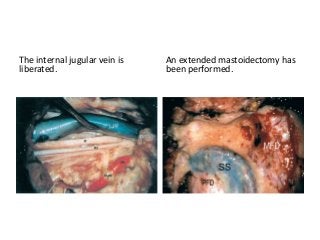 The internal jugular vein is
liberated.
An extended mastoidectomy has
been performed.
 