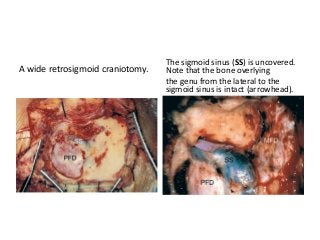 A wide retrosigmoid craniotomy.
The sigmoid sinus (SS) is uncovered.
Note that the bone overlying
the genu from the lateral to the
sigmoid sinus is intact (arrowhead).
 