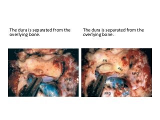 The dura is separated from the
overlying bone.
The dura is separated from the
overlying bone.
 