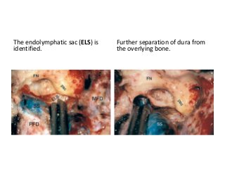 The endolymphatic sac (ELS) is
identified.
Further separation of dura from
the overlying bone.
 