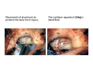 Placement of aluminum to
protect the dura from injury.
The cochlear aqueduct (CAq)is
identified.
 