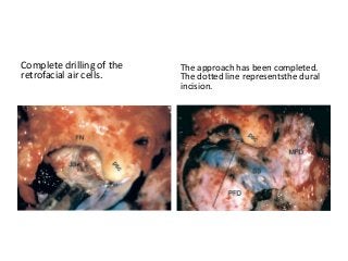 Complete drilling of the
retrofacial air cells.
The approach has been completed.
The dotted line representsthe dural
incision.
 