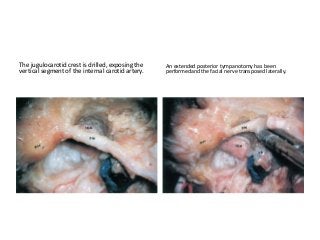 The jugulocarotid crest is drilled, exposing the
vertical segment of the internal carotid artery.
An extended posterior tympanotomy has been
performedand the facial nerve transposed laterally.
 