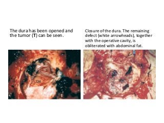 The dura has been opened and
the tumor (T) can be seen.
Closure of the dura. The remaining
defect (white arrowheads), together
with the operative cavity, is
obliterated with abdominal fat.
 
