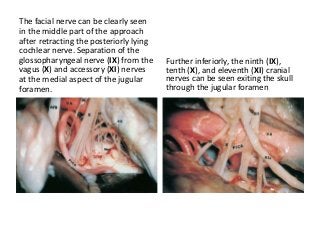 The facial nerve can be clearly seen
in the middle part of the approach
after retracting the posteriorly lying
cochlear nerve. Separation of the
glossopharyngeal nerve (IX) from the
vagus (X) and accessory (XI) nerves
at the medial aspect of the jugular
foramen.
Further inferiorly, the ninth (IX),
tenth (X), and eleventh (XI) cranial
nerves can be seen exiting the skull
through the jugular foramen
 