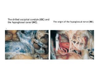 The origin of the hypoglossal nerve (XII).
.
The drilled occipital condyle (OC) and
the hypoglossal canal (HC).
 