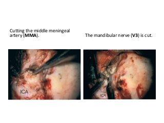 Cutting the middle meningeal
artery (MMA). The mandibular nerve (V3) is cut.
 