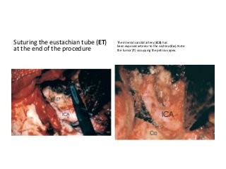 Suturing the eustachian tube (ET)
at the end of the procedure
The internal carotid artery (ICA) has
been exposed anterior to the cochlea (Co). Note
the tumor (T) occupying the petrous apex.
 