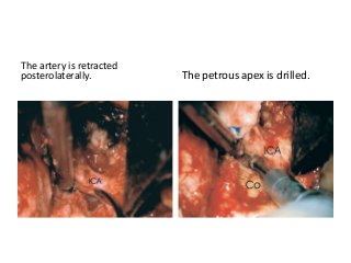 The artery is retracted
posterolaterally. The petrous apex is drilled.
 