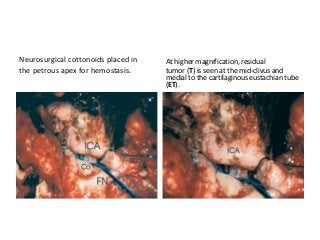 Neurosurgical cottonoids placed in
the petrous apex for hemostasis.
At higher magnification, residual
tumor (T) is seen at the mid-clivus and
medial to the cartilaginous eustachian tube
(ET).
 