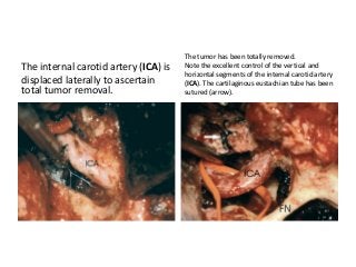 The internal carotid artery (ICA) is
displaced laterally to ascertain
total tumor removal.
The tumor has been totally removed.
Note the excellent control of the vertical and
horizontal segments of the internal carotid artery
(ICA). The cartilaginous eustachian tube has been
sutured (arrow).
 