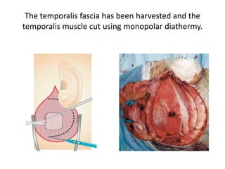 3 surfaces
2 upper surfaces 1 basal surface
 