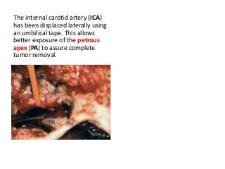 The internal carotid artery (ICA)
has been displaced laterally using
an umbilical tape. This allows
better exposure of the petrous
apex (PA) to assure complete
tumor removal.
 