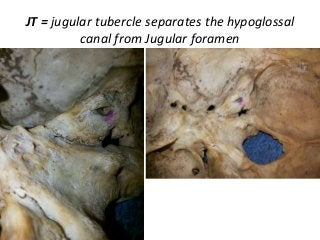 JT = jugular tubercle separates the hypoglossal
canal from Jugular foramen
 
