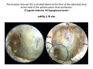 The foramen lacerum (FL) is located lateral to the floor of the sphenoid sinus
at the level of the spheno-petro-clival confuence.
JT jugular tubercle, HC hypoglossal canal –
addFig 3.78 also
 