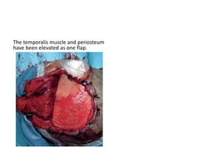 The petrous portion of the temporal
bone or pyramid is pyramidal
 