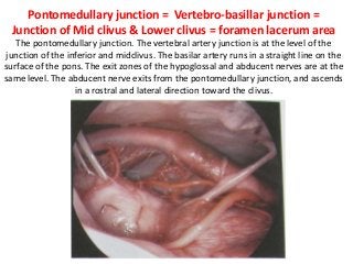 Pontomedullary junction = Vertebro-basillar junction =
Junction of Mid clivus & Lower clivus = foramen lacerum area
The pontomedullary junction. The vertebral artery junction is at the level of the
junction of the inferior and midclivus. The basilar artery runs in a straight line on the
surface of the pons. The exit zones of the hypoglossal and abducent nerves are at the
same level. The abducent nerve exits from the pontomedullary junction, and ascends
in a rostral and lateral direction toward the clivus.
 