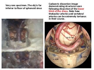Very rare specimen..The vbj is far
inferior to floor of sphenoid sinus
Cadaveric dissection image
demonstrating structures seen
following dissection of the lower
third of the clivus. Note how
thebasilar arteries and vertebral
arteries can be extremely tortuous
in their course.
 