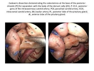 Cadaveric dissection demonstrating the osteotomies at the base of the posterior
clinoids (PC) for separation with the body of the dorsum sella (DS). P. CCA , posterior
genu of the intracavernous carotid artery; PCA, paraclival carotid artery; ICCA,
intracranial carotid artery; BA, basilar artery; PL, posterior lobe of the pituitary gland;
AL, anterior lobe of the pituitary gland.
 