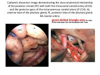 Cadaveric dissection image demonstrating the close anatomical relationship
of the posterior clinoid (PC) with both the intracranial carotid artery (ICCA)
and the posterior genu of the intracavernous carotid artery (P. CCA). AL,
anterior lobe of the pituitary gland; PL, posterior lobe of the pituitary gland;
BA, basilar artery.
green dotted triangle area for entry
of the endoscope into the interpeduncular fossa
 