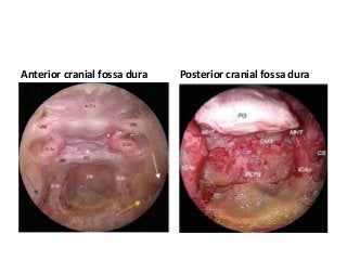 Anterior cranial fossa dura Posterior cranial fossa dura
 