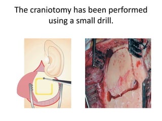 Petrous apex =Anterior Triangular ( T ) area +
Posterior Quadrangular ( Q ) area
 