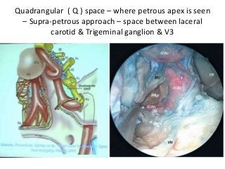 Quadrangular ( Q ) space – where petrous apex is seen
– Supra-petrous approach – space between laceral
carotid & Trigeminal ganglion & V3
 