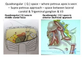 Quadrangular ( Q ) space – where petrous apex is seen
– Supra-petrous approach – space between laceral
carotid & Trigeminal ganglion & V3
Quadrangular ( Q ) area in
middle cranial fossa
Quadrangular ( Q ) space in
anterior skull base approach
 