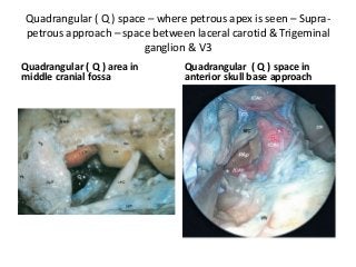 Quadrangular ( Q ) space – where petrous apex is seen – Supra-
petrous approach – space between laceral carotid & Trigeminal
ganglion & V3
Quadrangular ( Q ) area in
middle cranial fossa
Quadrangular ( Q ) space in
anterior skull base approach
 